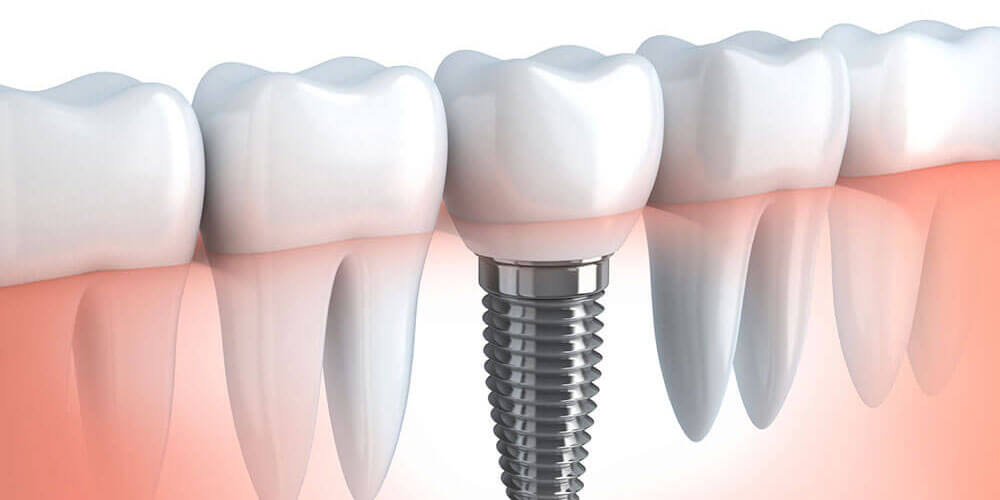 Dental Implants in Oakridge