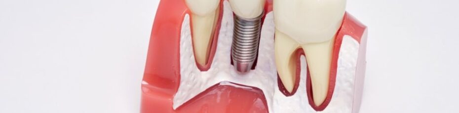 What to Expect During a Dental Implant Procedure