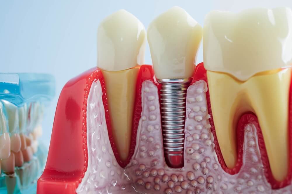 Root Canal vs. Tooth Extraction: Which is Best for Treating Infections?